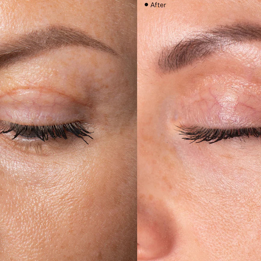Model - efter øjenlågsoperation og efter Skin Repair